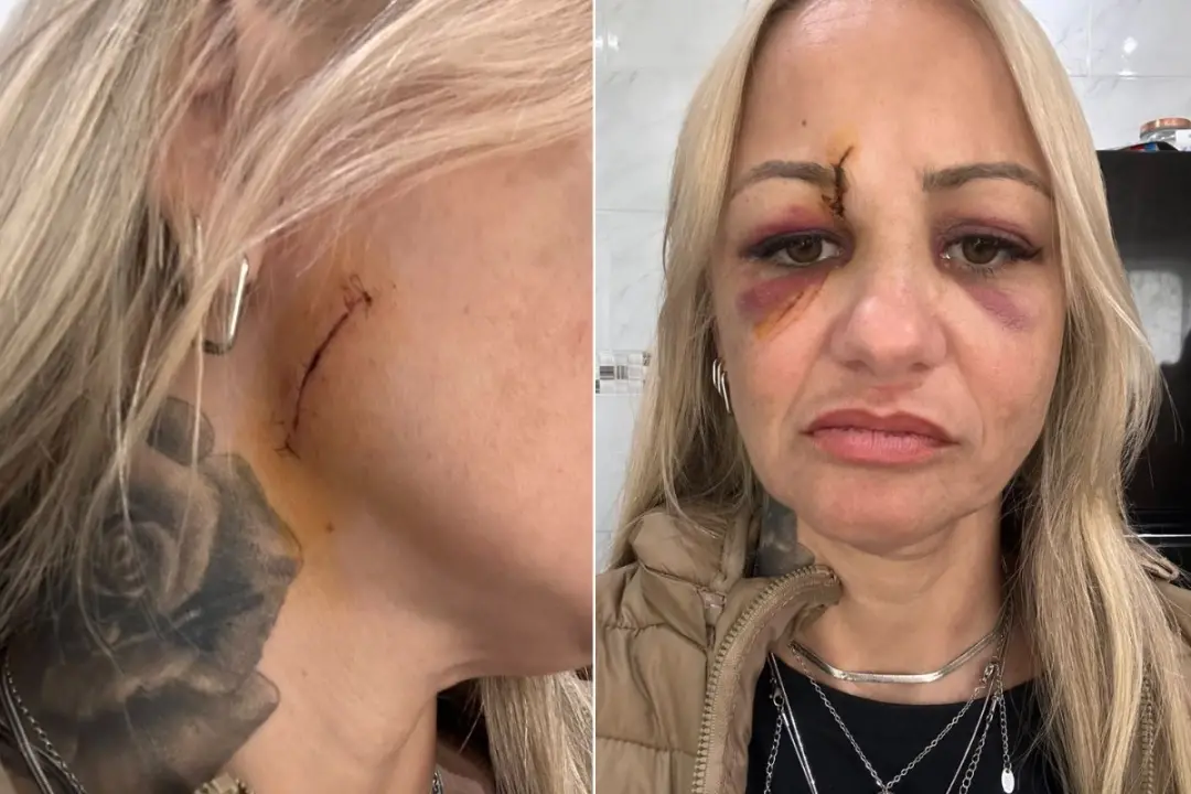 Praia Grande, litoral de SP. Uma cabeleireira de 45 anos levou 20 pontos no rosto após ser atingida com uma taça de vid…