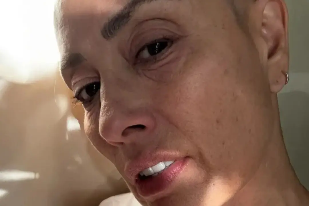 Melanie Sykes compartilha fotos com a cabeça raspada depois perder cabelos por alopecia. A decisão dela mostra que a ac…