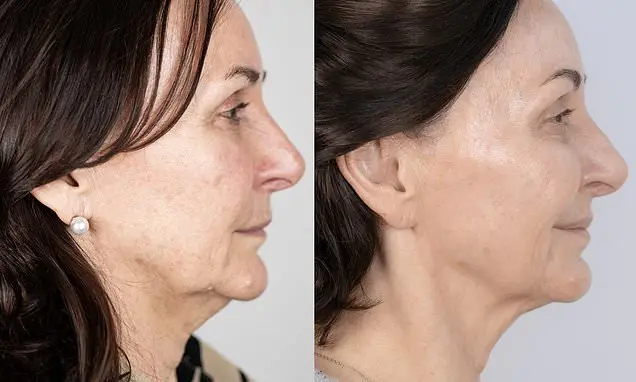 Shirley Ballas, 66 anos, mostra resultados de tratamentos estéticos de 4,5 mil libras, dizendo que está melhor que dez …