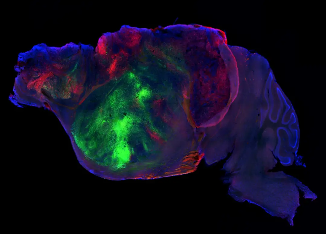 Sergiu Pasca implantou organoides de corteza cerebral humana em ratos geneticamente modificados. Um cérebro misto, com …
