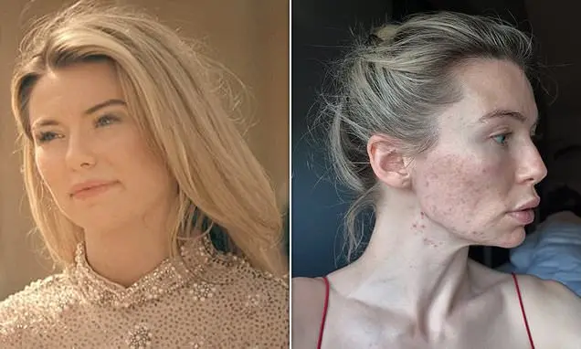 Georgia Toffolo recusou filmar Made In Chelsea quando estava lutando contra acne. É pesado ver a pressão de ter que mos…