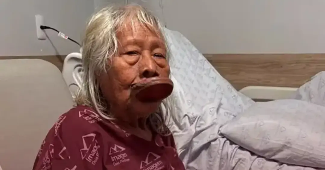 Cacique Raoni Metuktire, aos 94 anos, foi diagnosticado com um câncer agressivo no aparelho digestório, o que levou à d…