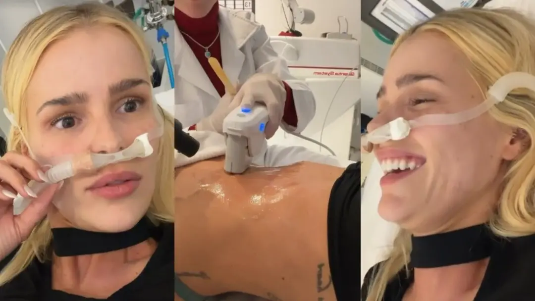 Yasmin Brunet usou ultrassom microfocado no abdômen com óxido nitroso para melhorar flacidez. O procedimento estético b…