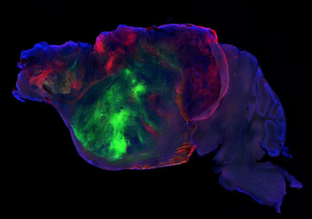 Organoides cerebrais humanos mesclaram com cérebros de camundongo, formando circuitos neurais ativos. Essa técnica abre…