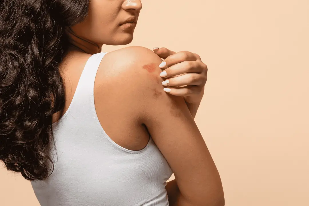 Setembro é o mês da conscientização sobre Dermatite Atópica, doença crônica que vai além da pele. A inflamação pode afe…