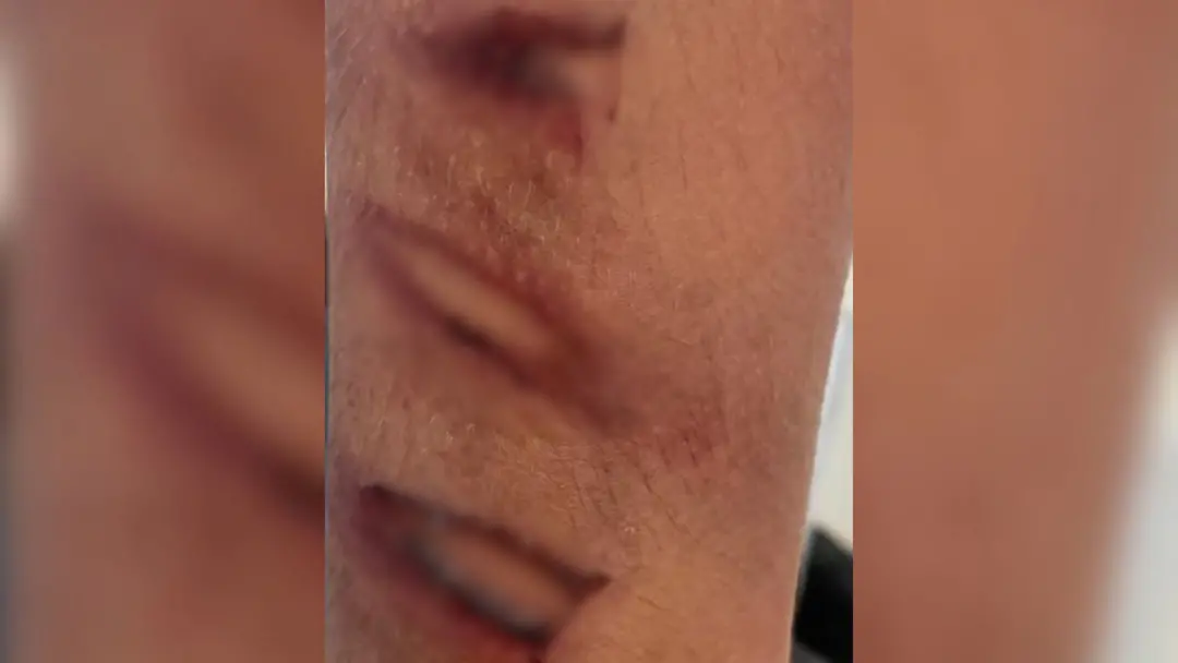 Araçatuba, em São Paulo, viu um homem preso por maus-tratos após espancar enteado de 10 anos com pedaço de mangueira. A…