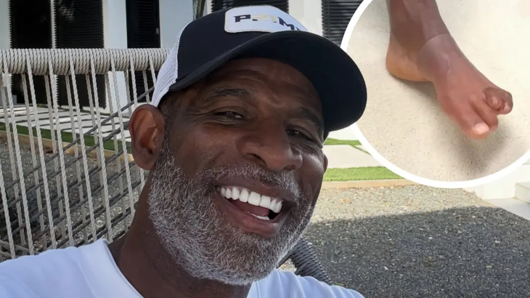 Deion Sanders mostra as próteses de dedos no pé esquerdo após a amputação de 2021. A recuperação dele é um sinal de res…
