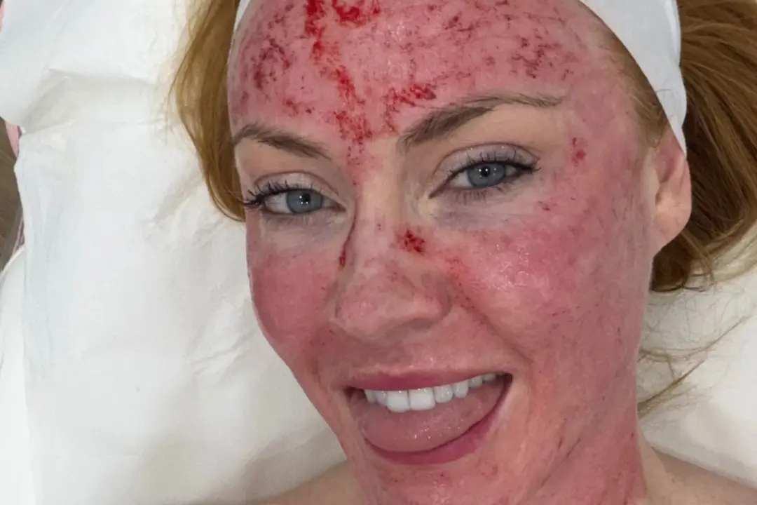 Wife do Chris Robshaw mostrou foto do rosto ensanguentado após tratamento de pele, meses depois de Camilla Kerslake usa…