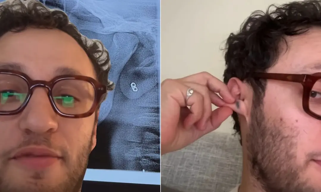 Matt Aitia descobriu uma tarraxa no lóbulo da orelha depois de 20 anos, quando ele tinha 29 anos. Por anos os médicos d…