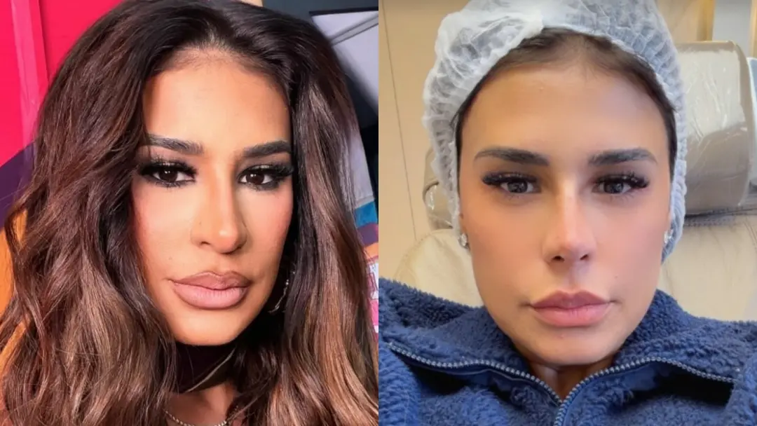 Simone Mendes usa fios de tração para elevar a ponta do nariz, dizendo que não foi rinoplastia. Essa técnica só altera …