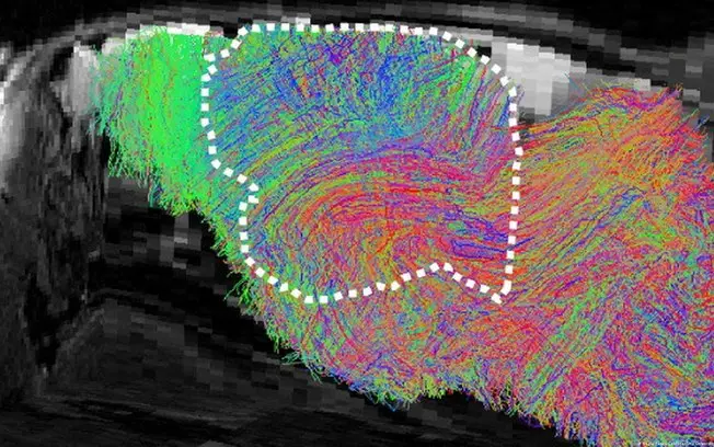 Tecido cerebral humano cultivado foi transplantado em ratos geneticamente modificados. Isso abre caminho para estudar d…