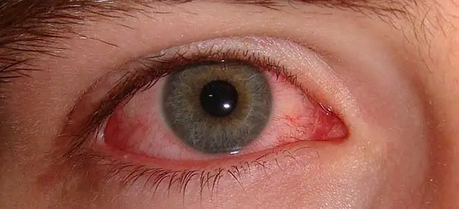 Um estudo aponta que pessoas com deficiência visual têm 2,5 vezes mais risco de comportamento suicida. A perda da visão…