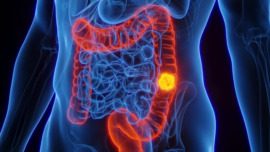 Um em cinco casos de câncer colorretal pode estar ligado a uma bactéria do estômago, a Helicobacter pylori. A exposição…