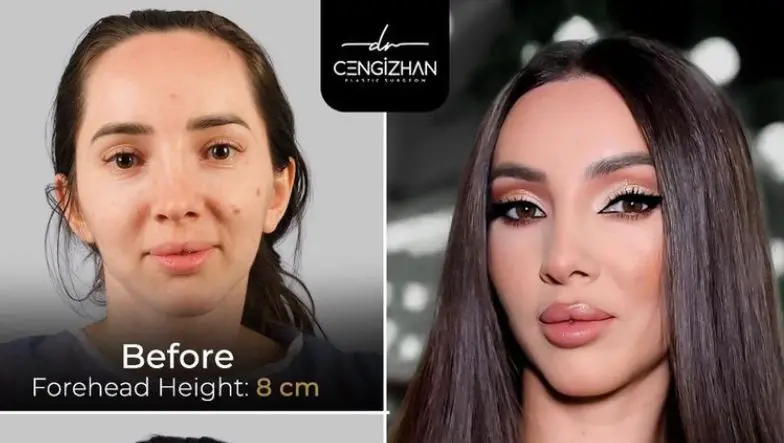 Um procedimento chamado Forehead Reduction Surgery na Turquia busca criar uma linha de cabelo mais baixa para proporçõe…
