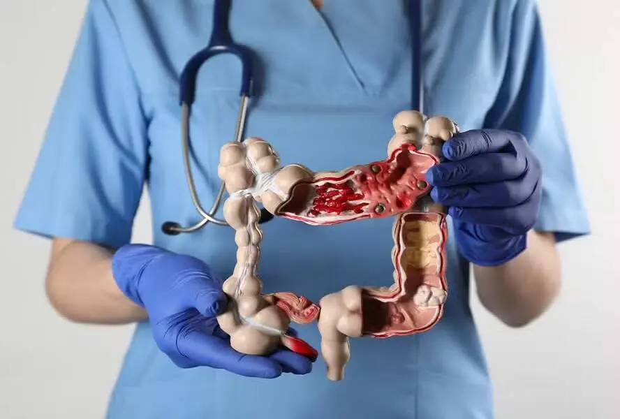 Mais de cinco vezes o número de pessoas com doenças inflamatórias intestinais aumentou no Brasil em 13 anos, indo de 30…