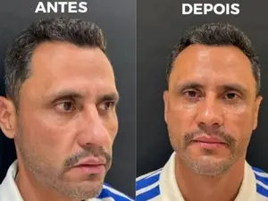 Cleitinho fez procedimentos estéticos um dia depois de ser eleito governador de Minas Gerais. Não é justo que ele use o…
