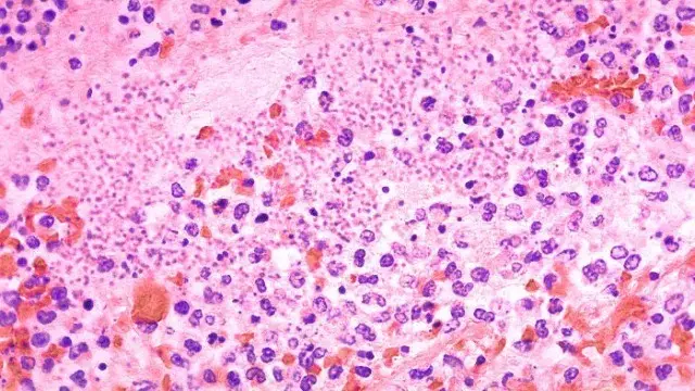 Irkutsk, na Sibéria, teve um funcionário de instituto diagnosticado com pneumonia de origem desconhecida. A ausência de…