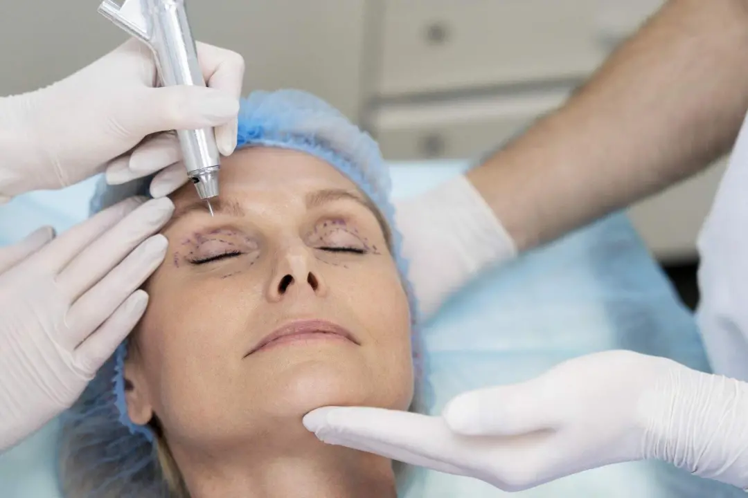 O olhar cansado depois de dormir pode ter causa estrutural na região dos olhos. Cirurgia blefaroplastia remove ou repos…