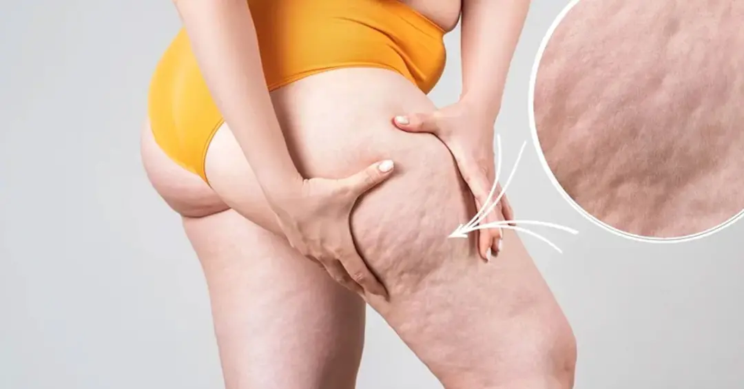 8,8 milhões de mulheres adultas no Brasil têm sinais compatíveis com lipedema. Essa condição, que se parece com excesso…