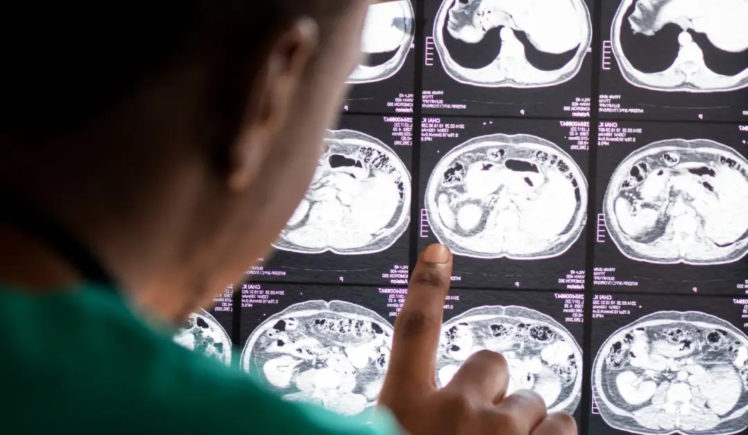 Universidade de Birmingham, no Reino Unido, identificou caminho para reduzir neuroinflamação no Alzheimer bloqueando o …