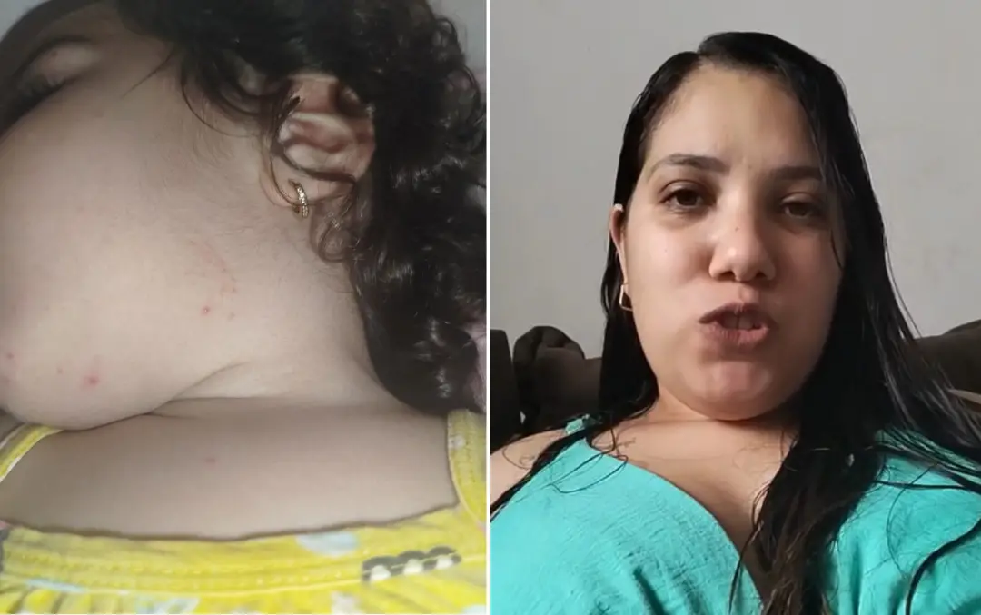 Manchas e coceira espalharam por uma família de Brodowski, SP, começando em uma bebê de 1 ano e 4 meses. O Instituto Ad…