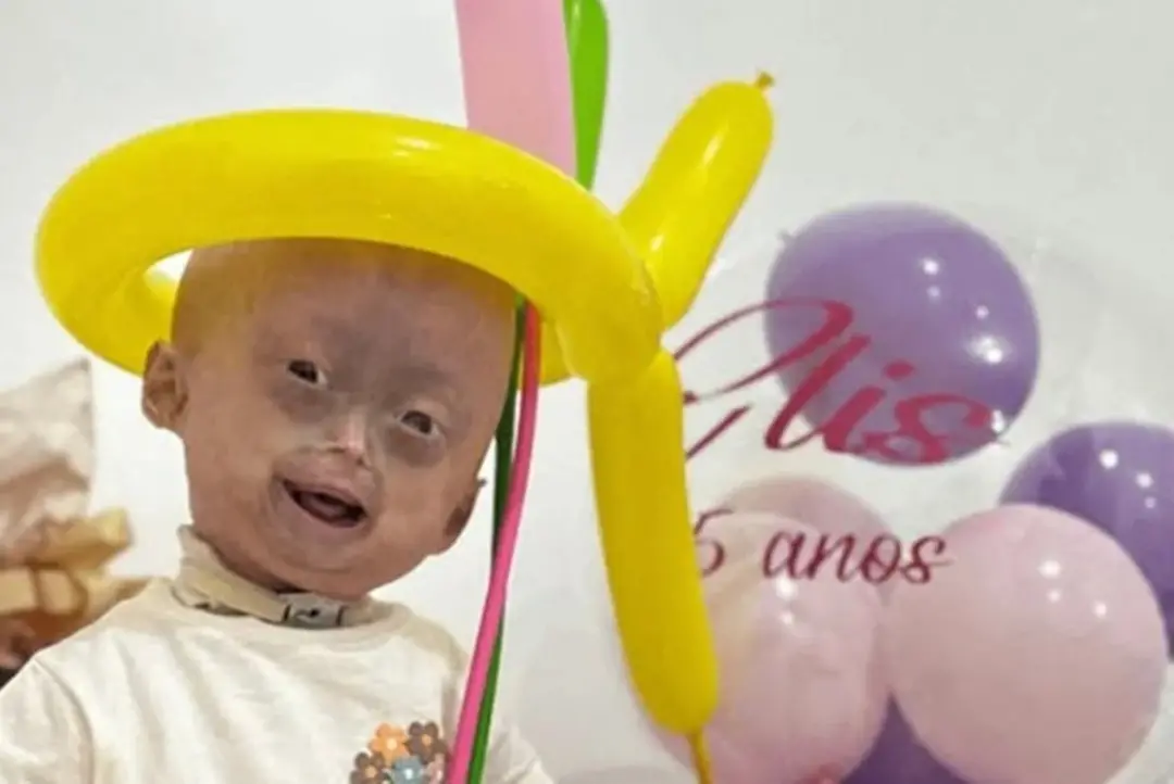 Elis, uma das gêmeas diagnosticadas com progéria, faleceu aos 5 anos em Boa Vista, RR. A mãe descreve a menina como enc…