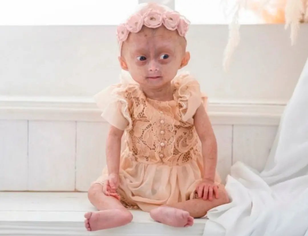 Elis Kamila Lima Carneiro, de 5 anos, faleceu em Boa Vista, Roraima. A menina sofria de síndrome progéria, condição que…