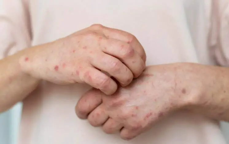 49.720 atendimentos de Herpes-zóster no Brasil em 2025, com São Paulo liderando os registros. A falta de vacina no SUS …