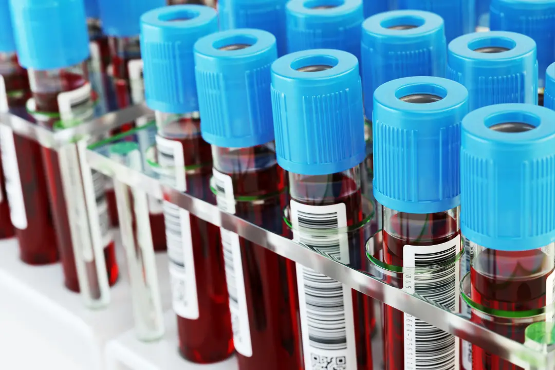 Anvisa aprovou o exame de sangue Elecsys pTau217 para ajudar no diagnóstico de Alzheimer. Puder fazer isso com sangue, …