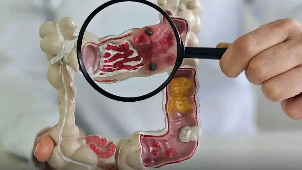 Cinco vezes o número de casos de doenças intestinais cresceu no Brasil entre 2012 e 2025, passando de 30 para 158 por 1…