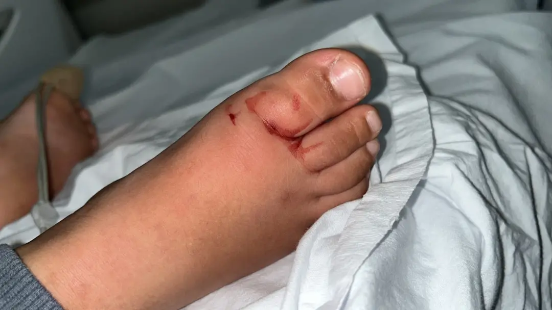 Duas crianças, de três e dois anos, foram picadas por escorpião em creche de Capivari em menos de uma semana. O control…