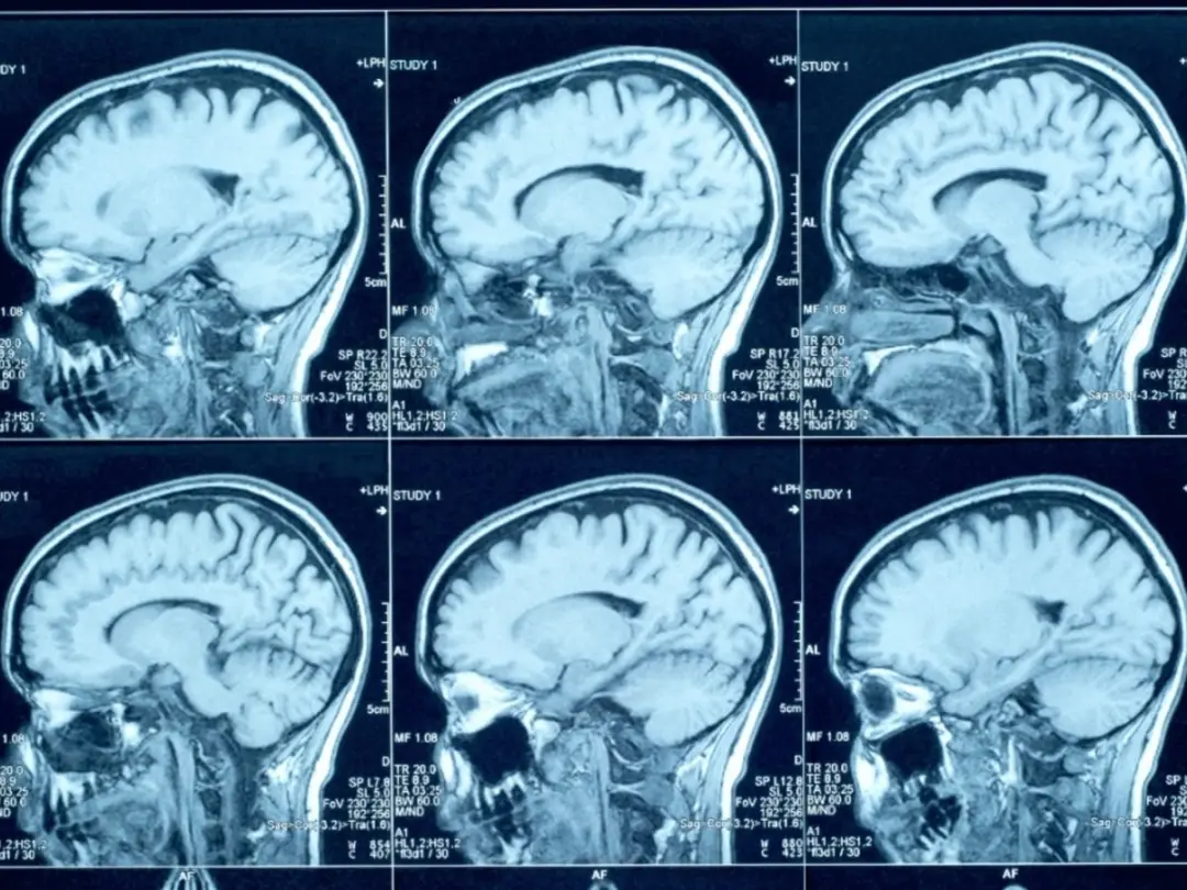 Queda em idosos pode causar sangramento cerebral que só dá sinal semanas depois. O envelhecimento diminui o volume cere…