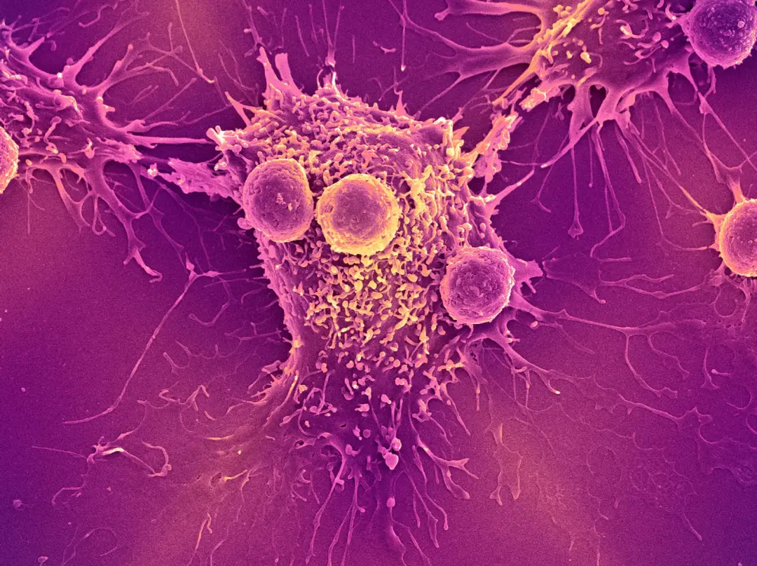 Teste de sangue para múltiplos cânceres superou uma etapa crucial e segue rumo à aprovação pela FDA. Acredito que isso …