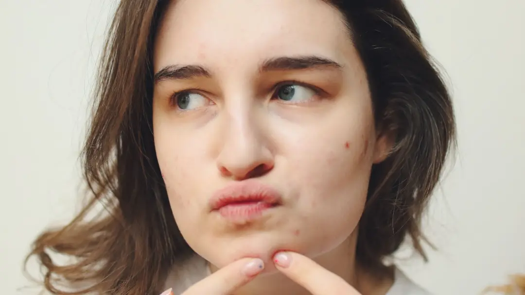 Diferentes tipos de cicatriz de acne existem, indo de depressões suaves a marcas elevadas. Essa variação mostra que o t…