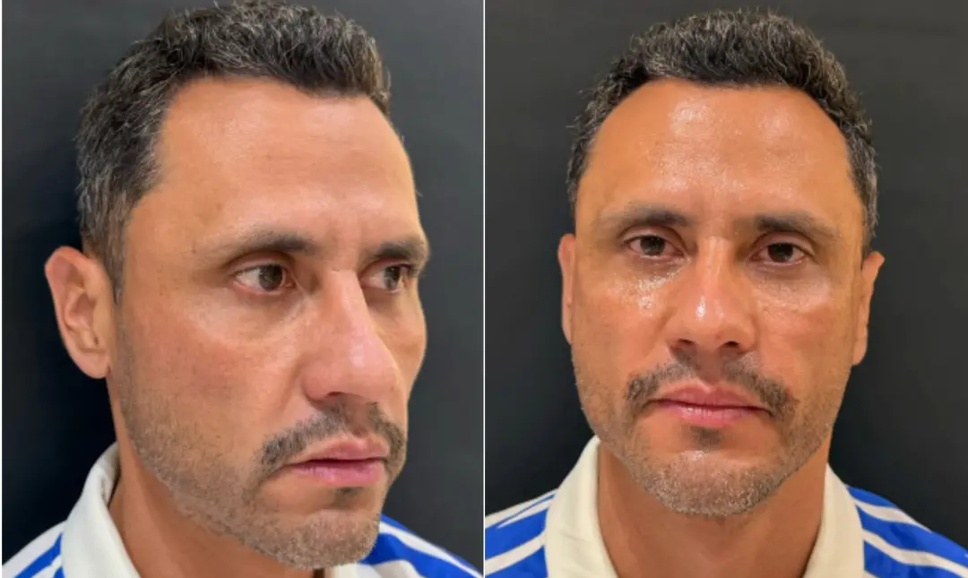 Cleitinho Azevedo fez harmonização facial no dia seguinte à eleição para governador de Minas Gerais. Faz sentido que el…