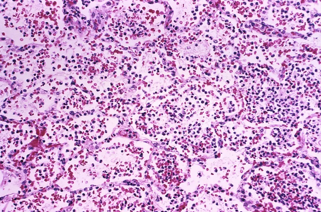 Sibéria, na Rússia, investiga morte de funcionária de laboratório por pneumonia, com suspeita de peste pneumônica. É um…