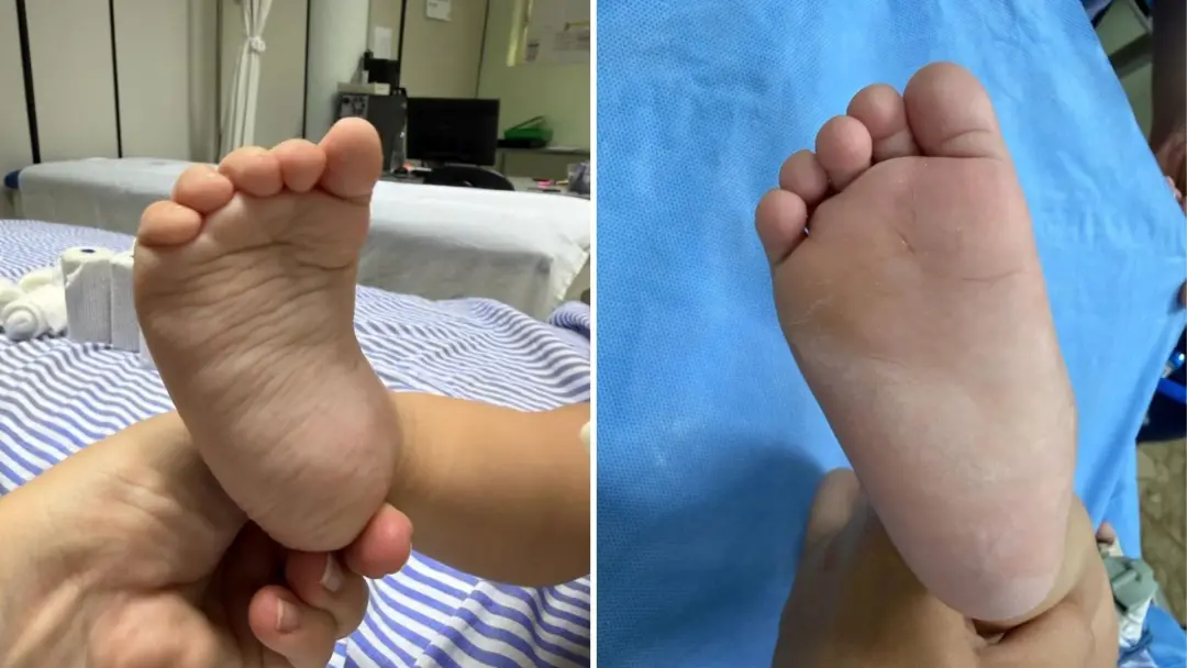 Araçatuba, SP: a filha de mãe conseguiu dar os primeiros passos com tratamento do pé torto pelo SUS. Ver essa evolução …