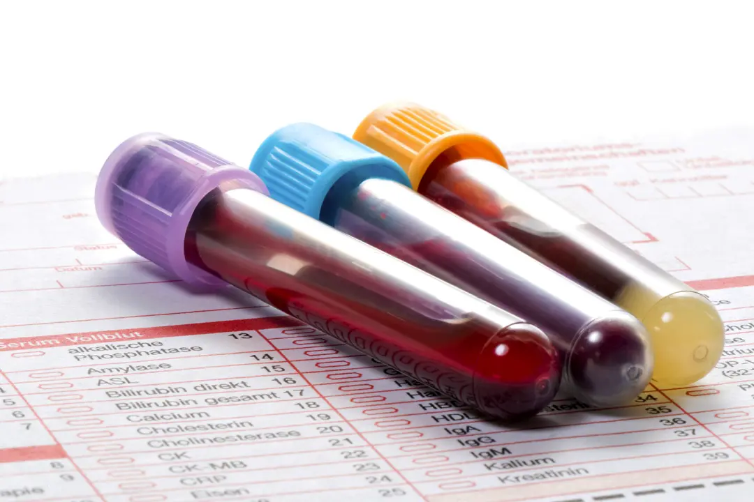 Anvisa aprovou o exame de sangue pTau217, que mede a proteína tau e indica alterações cerebrais típicas do Alzheimer. E…