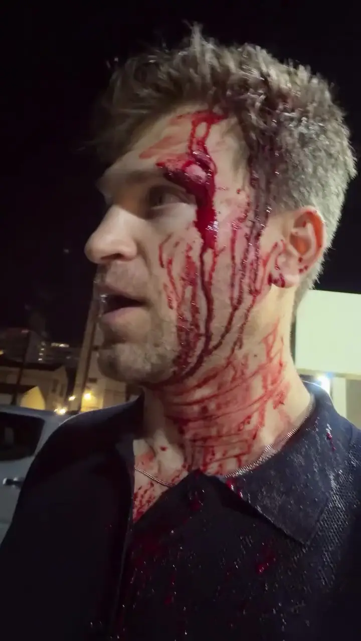 Keegan Allen foi assaltado a tiros e facadas em Los Angeles, fora de uma loja de mercado chique. A violência nessas áre…