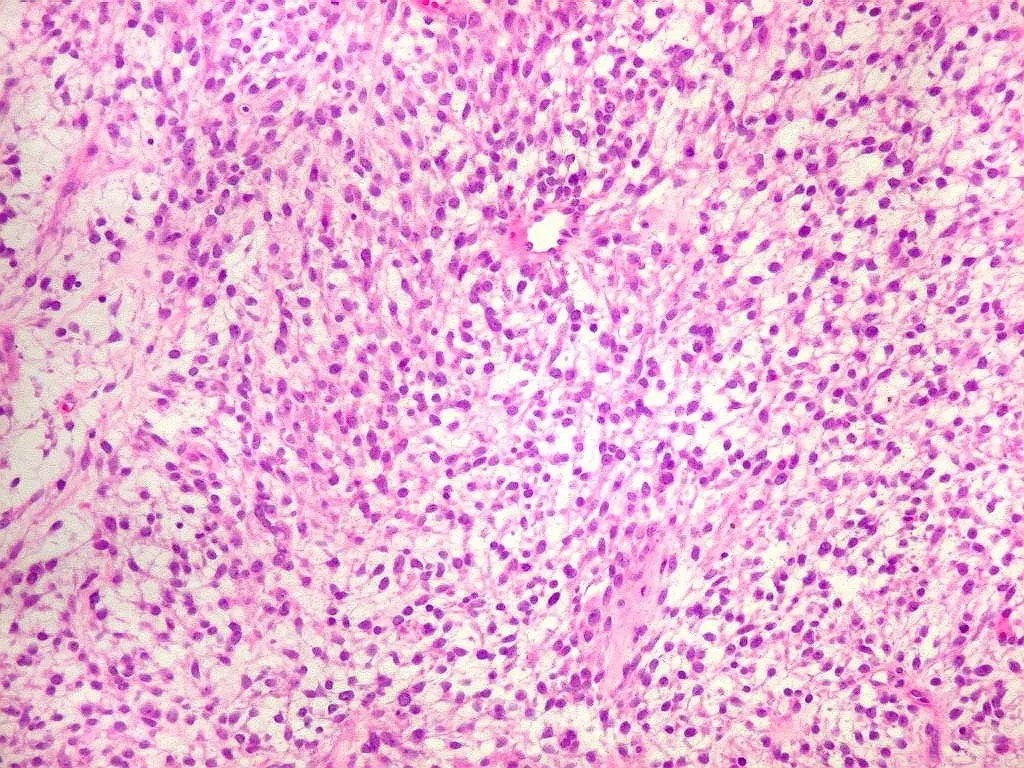 Gêmeas desenvolveram sarcoma de tecidos moles enquanto estavam na barriga. A análise da placenta mostrou que as células…