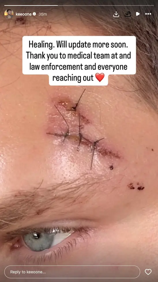 Keegan Allen, ator, sofreu um ataque armado e com faca em West Hollywood. É um choque ver tanta violência em lugares qu…