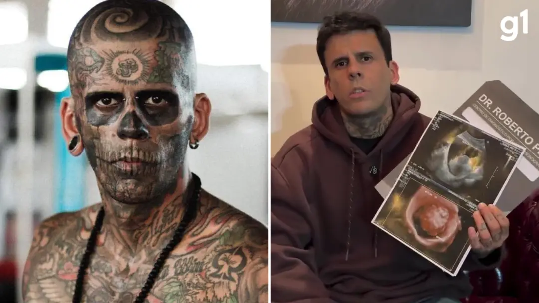 Leandro de Souza, o homem mais tatuado do Brasil, enfrentará cirurgia para retirada da bexiga devido a um câncer malign…