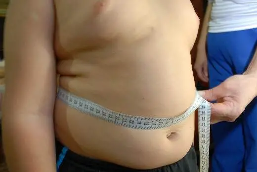 A OMS liberou orientações para obesidade em crianças e adolescentes de 0 a 19 anos, permitindo medicamentos e cirurgia …