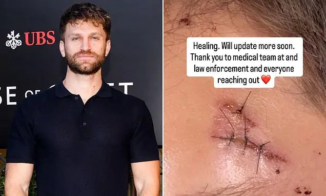 Keegan Allen mostrou foto de rosto costurado após ser roubado a tiros. É sério ver a violência desse jeito acontecendo.…