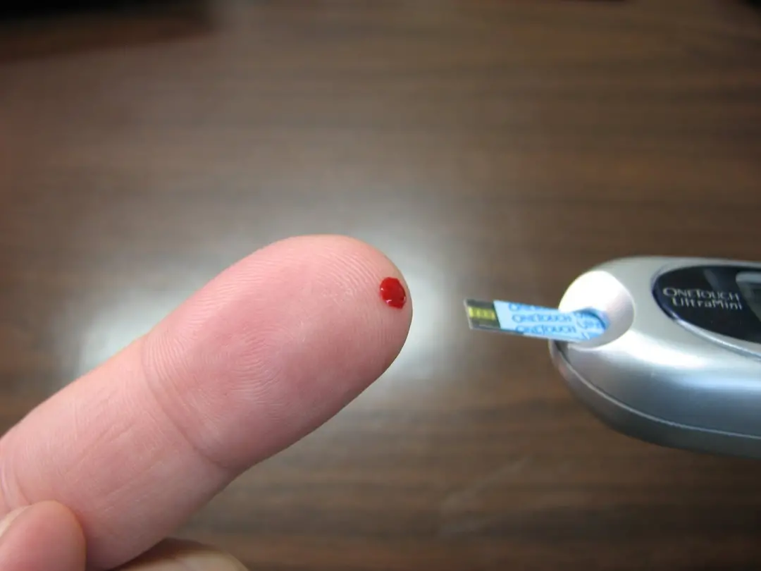 Diabetes não controlado causa inflamação e obstrução dos vasos, o que dificulta a cicatrização de feridas, como as dos …